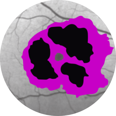 Lesion Growth Over Time